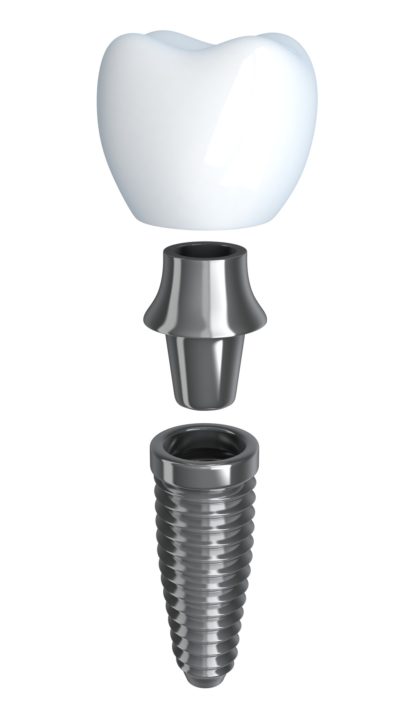 Tooth implant disassembled (done in 3d, isolated)
